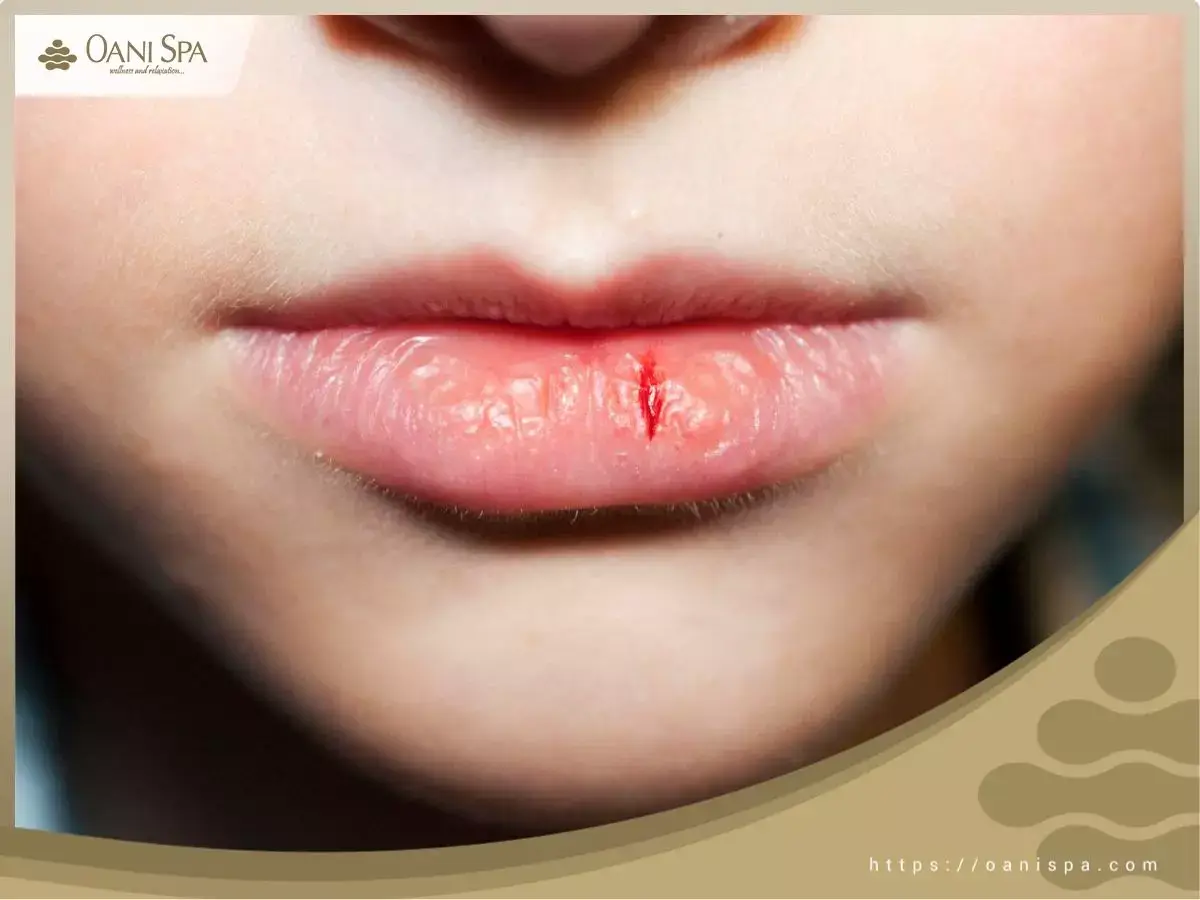 Tại sao phải tẩy tế bào chết cho môi