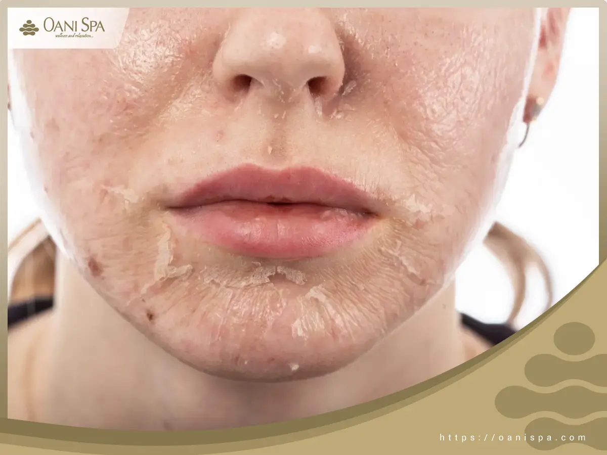 chăm sóc da sau peel Tình trạng da bị đóng mài sau quá trình peel da