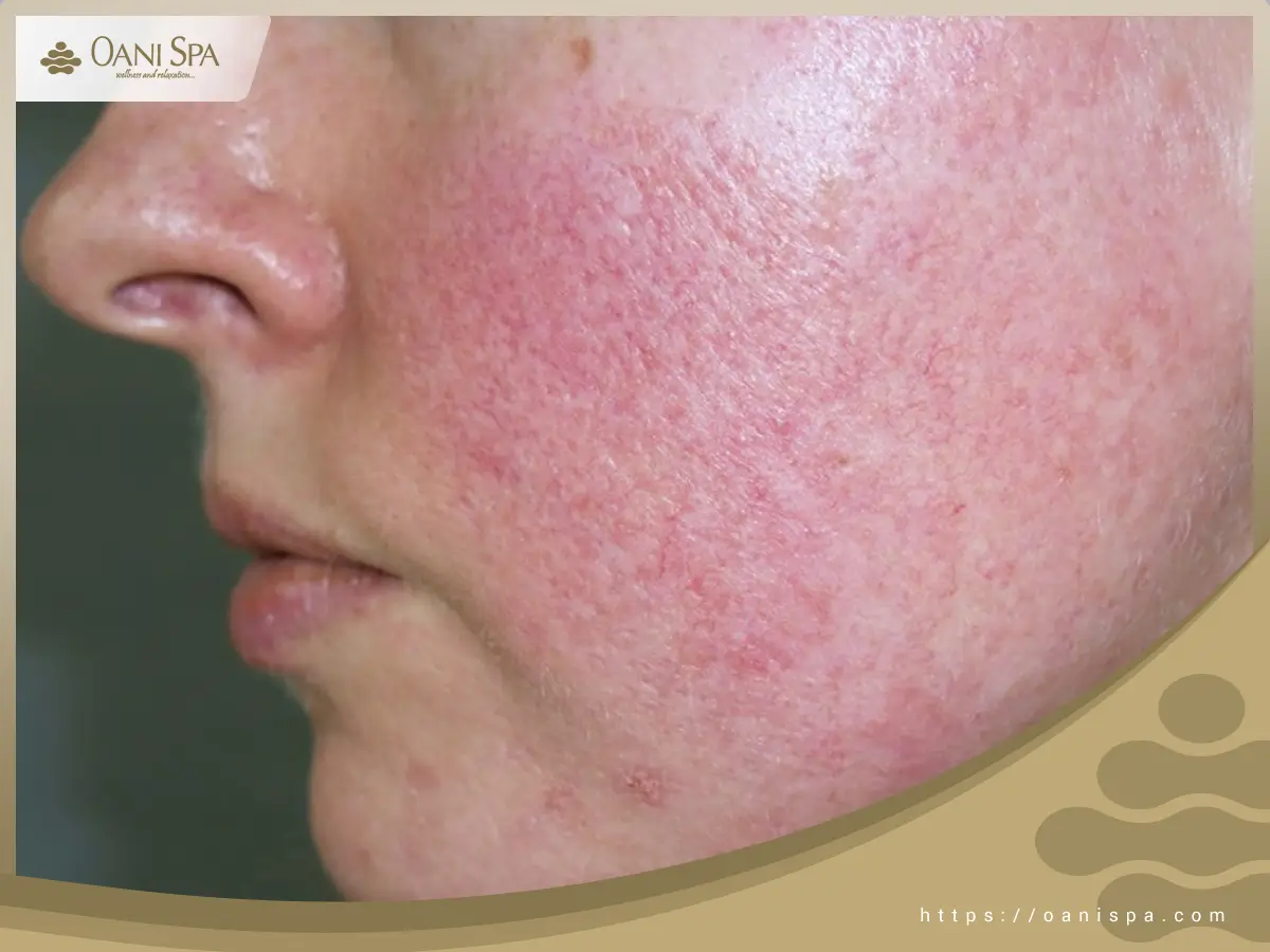 chăm sóc da sau peel Da sẽ có tình trạng ửng đỏ và cảm giác đau rát sau peel