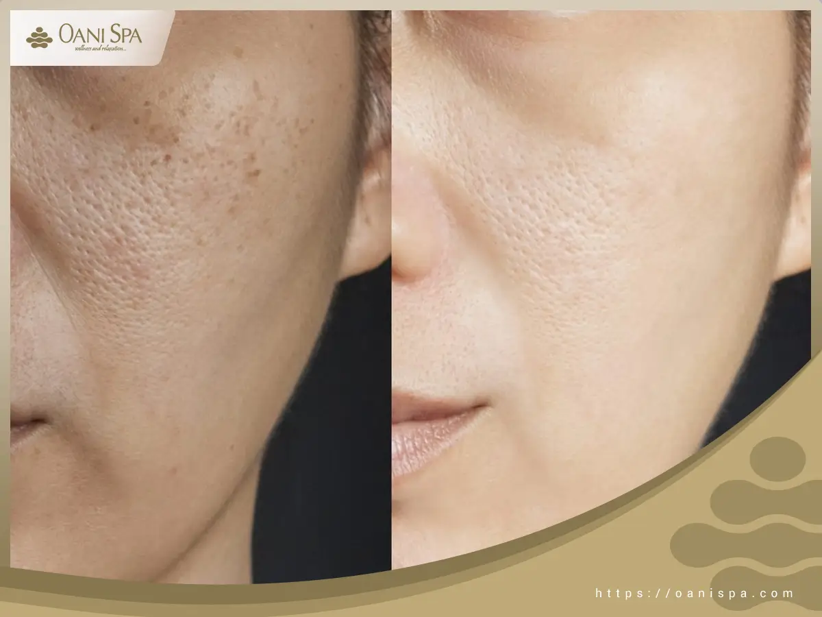 chăm sóc da sau peel Peel da giúp cải thiện tình trạng mụn và màu sắc của da