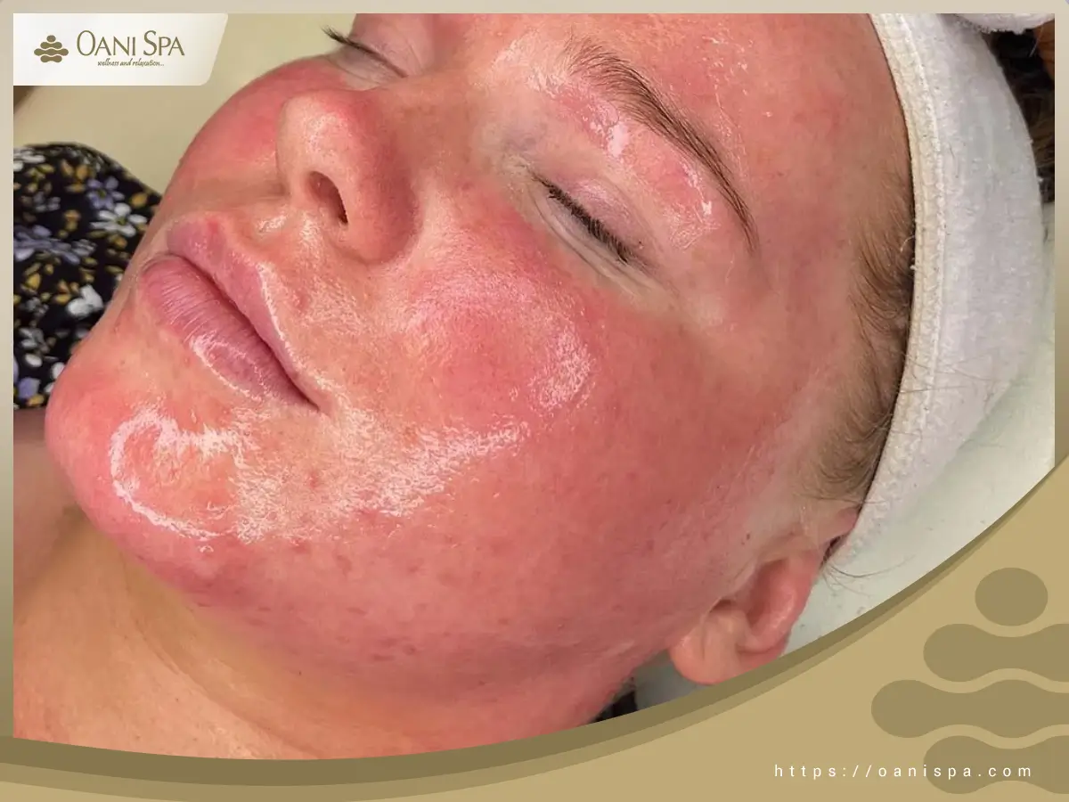 chăm sóc da sau peel Để quá trình peel da đạt kết quả tốt nhất, bạn nên sử dụng các sản phẩm lành tính, không có tính tẩy rửa mạnh