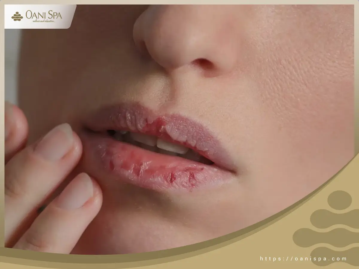 Không chăm sóc môi thường xuyên khiến da môi bị khô và bong tróc