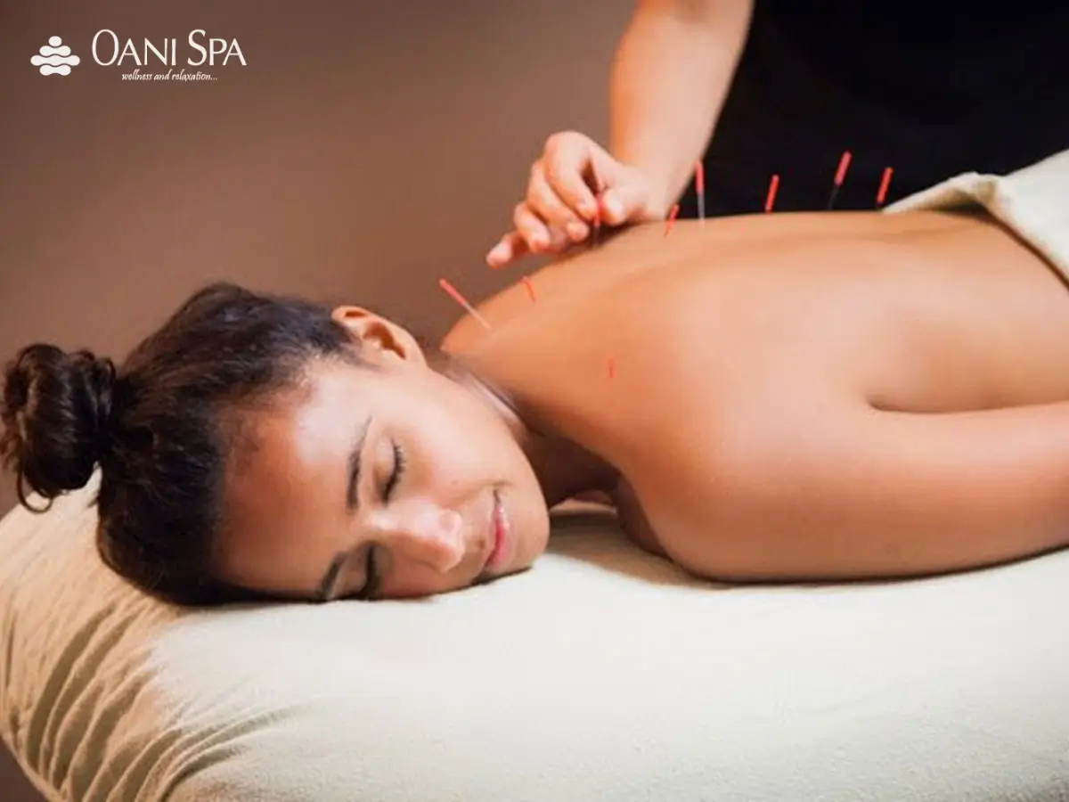 Phương pháp châm cứu chữa bệnh đau đầu.