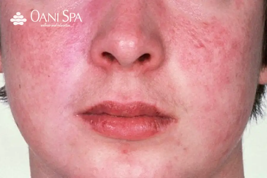 cách chăm sóc da mặt bị ứng dụng Các chất đỏ xuất hiện khi tiếp xúc với chất gây dị ứng