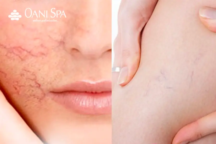 cách chăm sóc da mặt bị ứng dụng Histamine tạo ra các mạch máu dưới da mở rộng