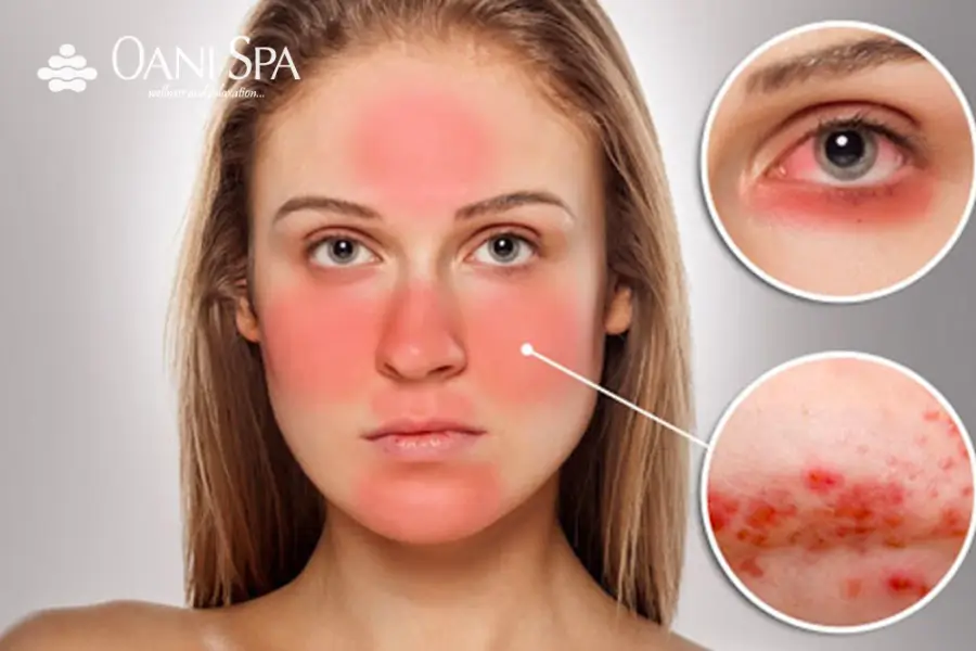 cách chăm sóc da mặt bị ứng dụng cách chăm sóc da mặt bị ứng dụng