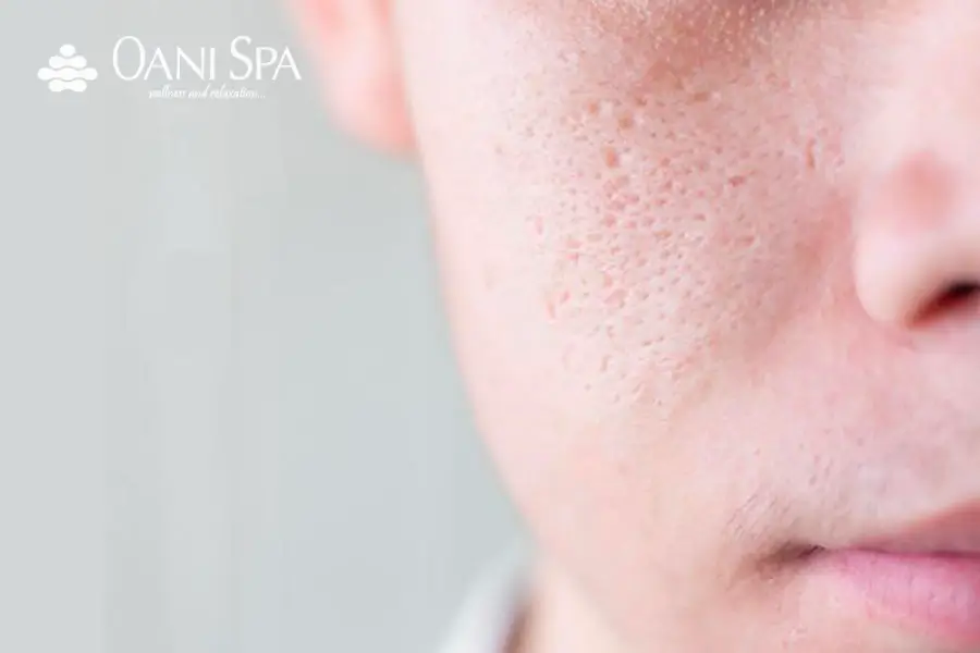 Chăm sóc da mặt bị sẹo rỗ 