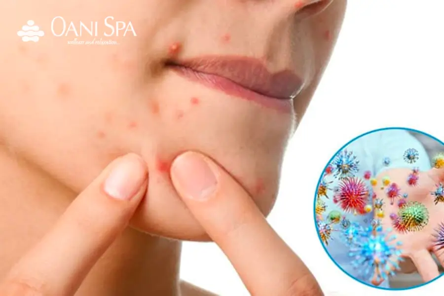 Tự nặn mụn tạo ra sẹo rỗ.