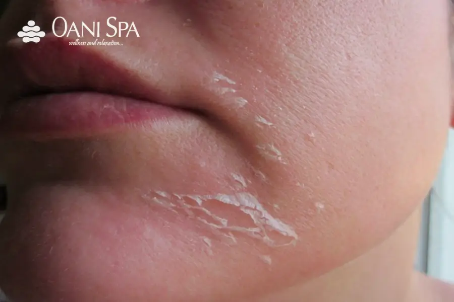 Không nên gãi hoặc cố ý lột vảy da