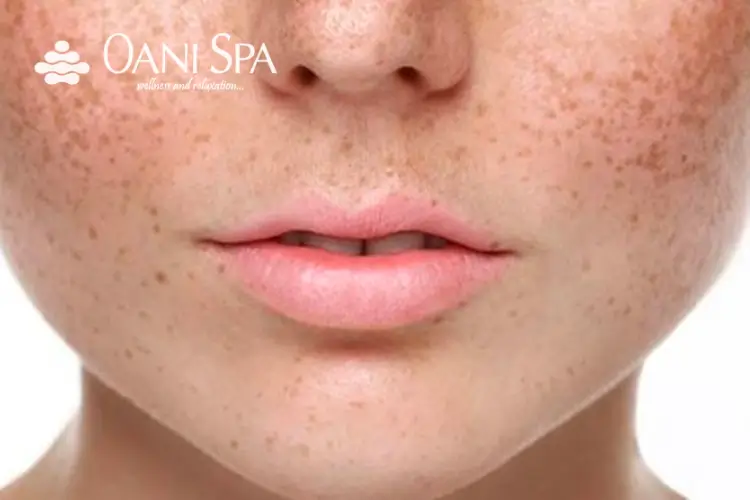 chăm sóc da mặt sau sinh Những vết nám và tàn nhang thường xuất hiện