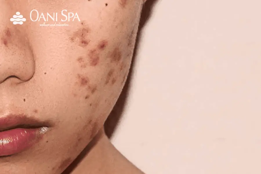 Thâm sẹo và tàn nhang