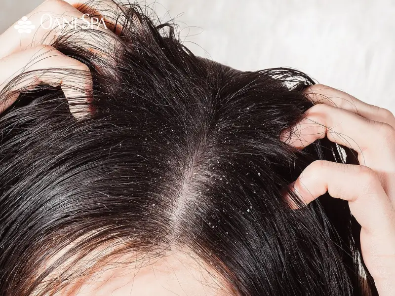 tẩy tế bào chết tóc Vì sao cần tẩy tế bào chết cho tóc