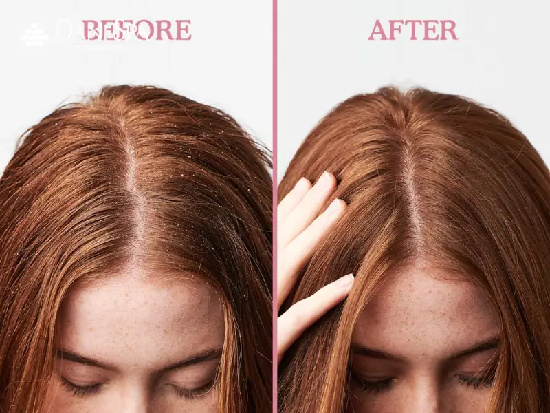 tẩy tế bào chết tóc Những hạn chế khi tẩy tế bào da đầu và tóc