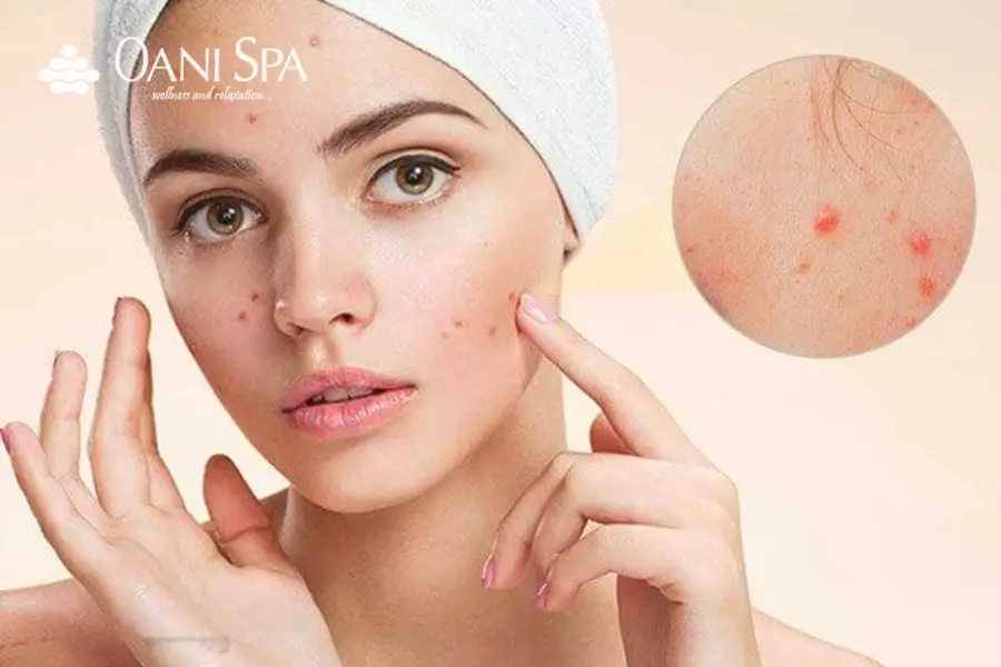 Triệt lông mặt có bị nổi mụn không Triệt lông mặt có bị nổi mụn không