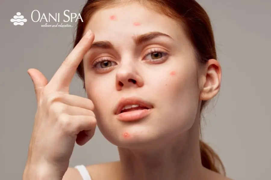 Triệt lông mặt có bị nổi mụn không Cách xử lý khi triệt lông mặt bị lên mụn