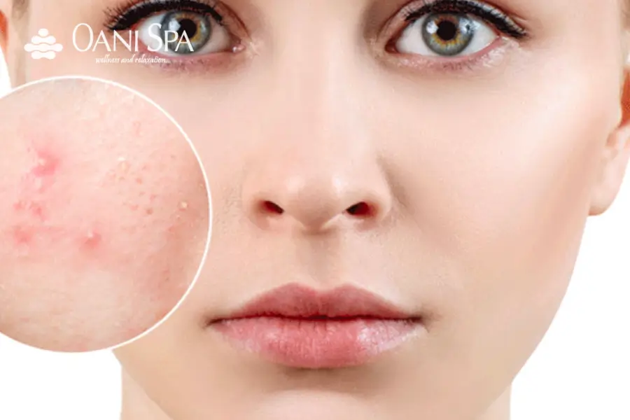 Triệt lông mặt có hết mụn không