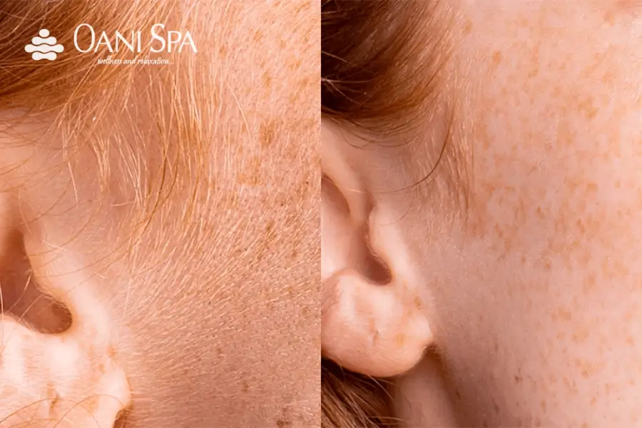 Những lưu ý sau khi triệt lông mặt