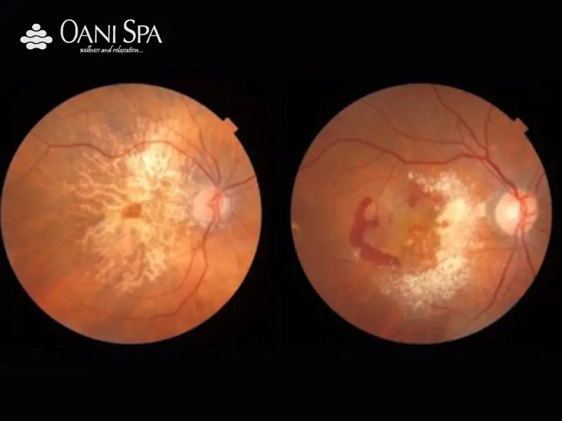 Tác dụng của vitamin B12 Giảm thiểu nguy cơ thoái hóa điểm vàng