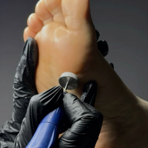 Cracked Heels - Earpick - Best nail care near me