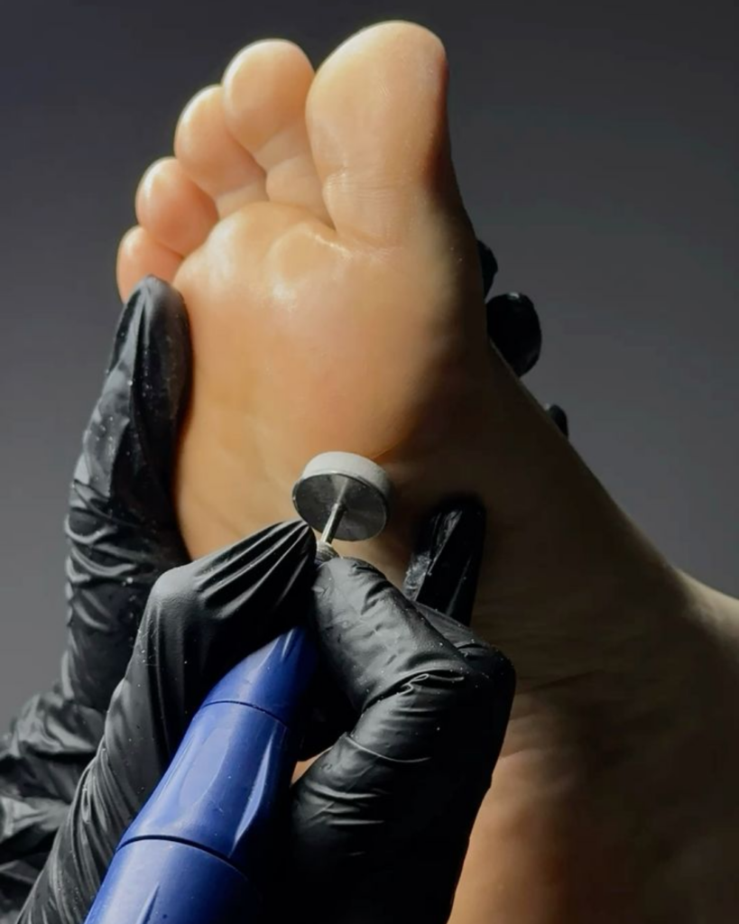 Cracked Heels - Earpick - Best nail care near me
