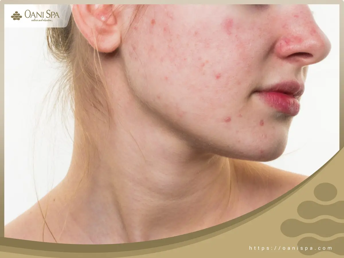 Chăm sóc da mụn Bạn cần tìm hiểu loại da trước khi điều trị