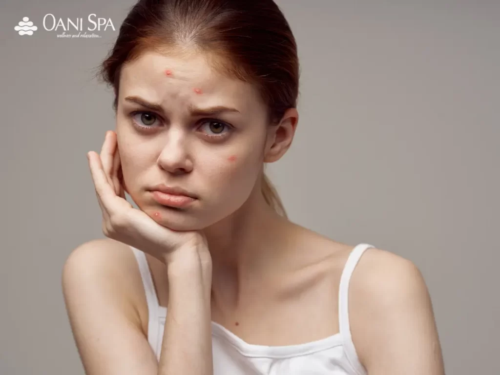 chăm sóc da mặt Da mụn sẽ khiến da trong kém sắc hơn